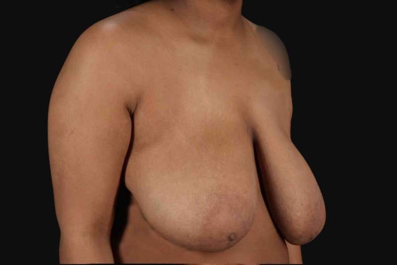 Breast Reduction With Lift Before & After Patient #3422