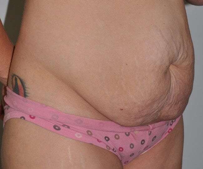 Abdominoplasty (Tummy Tuck) Before & After Patient #855