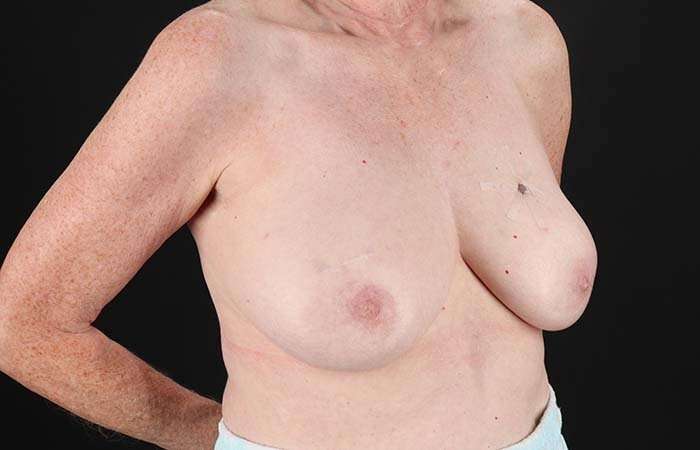 Implant Based Reconstruction Before & After Patient #3527
