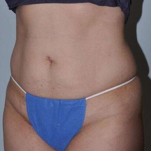 Abdominoplasty (Tummy Tuck) Before & After Patient #862