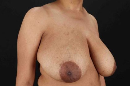 Breast Lift Before & After Patient #3626