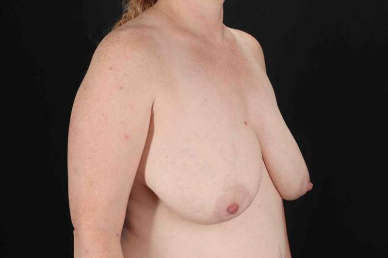 Breast Lift Before & After Patient #3684