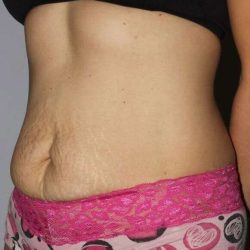 Abdominoplasty (Tummy Tuck) Before & After Patient #867
