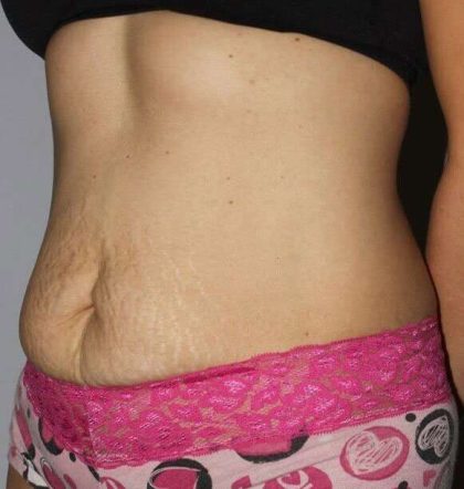 Abdominoplasty (Tummy Tuck) Before & After Patient #867