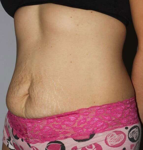 Abdominoplasty (Tummy Tuck) Before & After Patient #867
