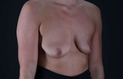 Breast Lift Before & After Patient #3750