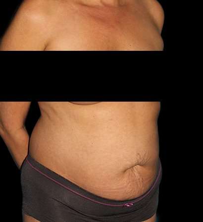 Abdominoplasty (Tummy Tuck) Before & After Patient #590