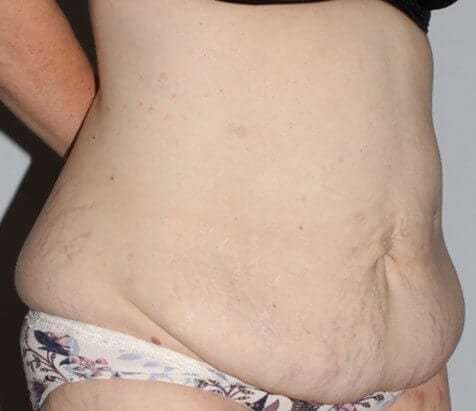 Abdominoplasty (Tummy Tuck) Before & After Patient #874