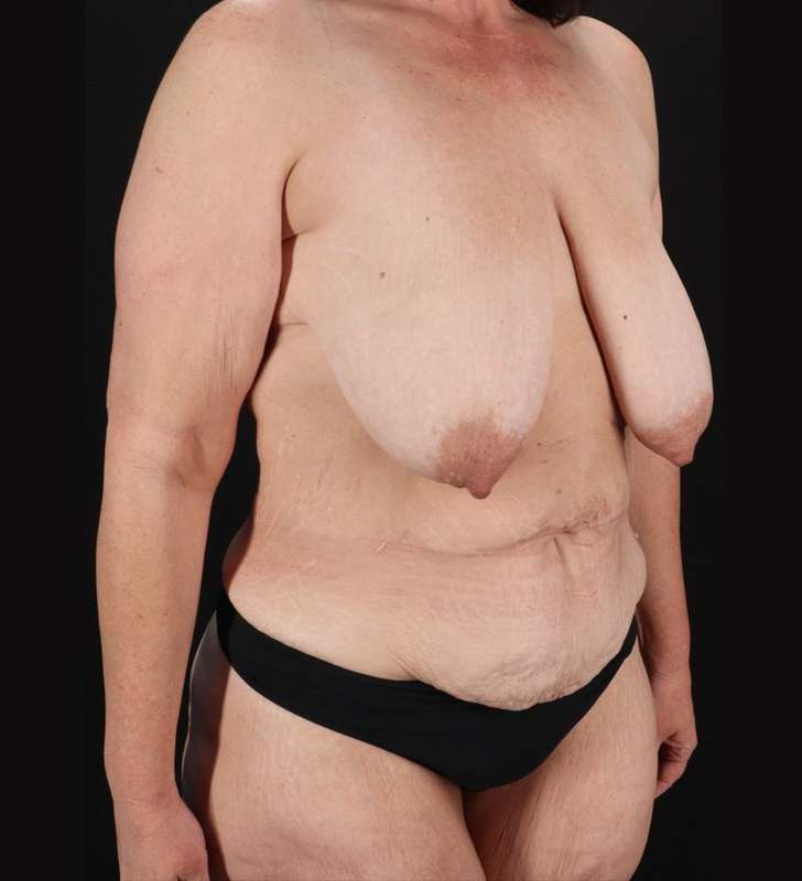 Breast Lift Before & After Patient #3853