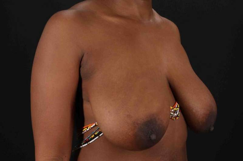 Breast Lift Before & After Patient #3875