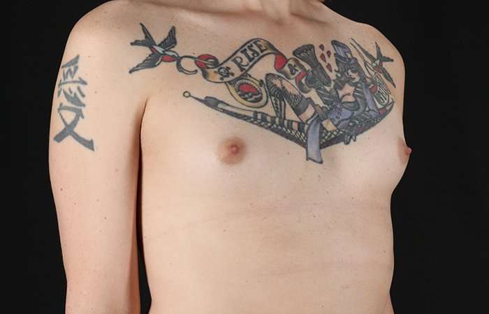 Male To Female Breast Before & After Patient #3886
