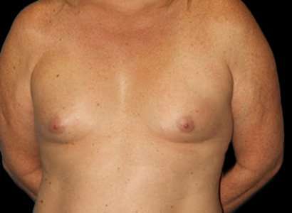 Male To Female Breast Before & After Patient #3893