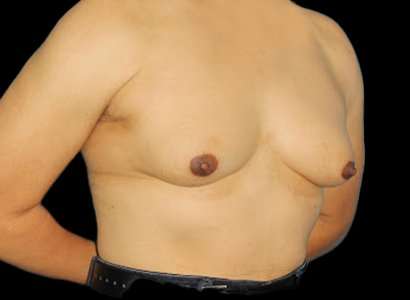 Male To Female Breast Before & After Patient #3900