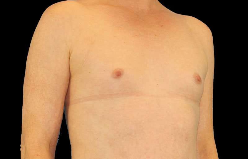 Male To Female Breast Before & After Patient #3911
