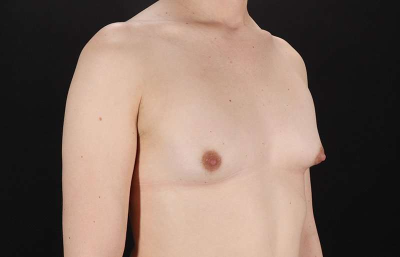 Male To Female Breast Before & After Patient #3933