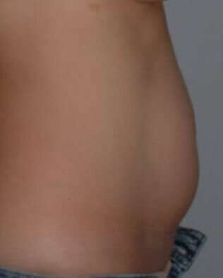 Abdominoplasty (Tummy Tuck) Before & After Patient #881