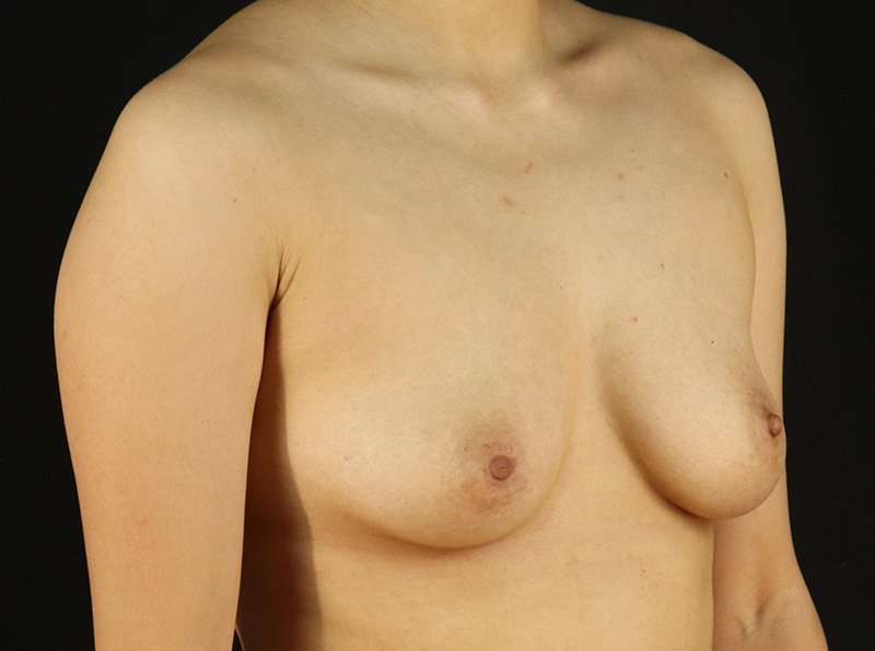 Female To Male Breast Before & After Patient #3944