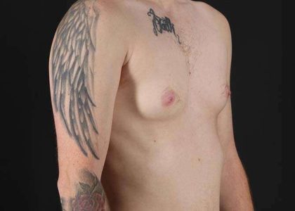 Female To Male Breast Before & After Patient #3955