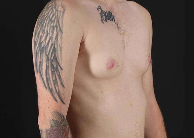 Female To Male Breast Before & After Patient #3955