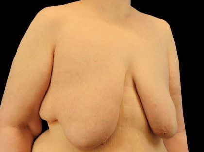 Female To Male Breast Before & After Patient #3966