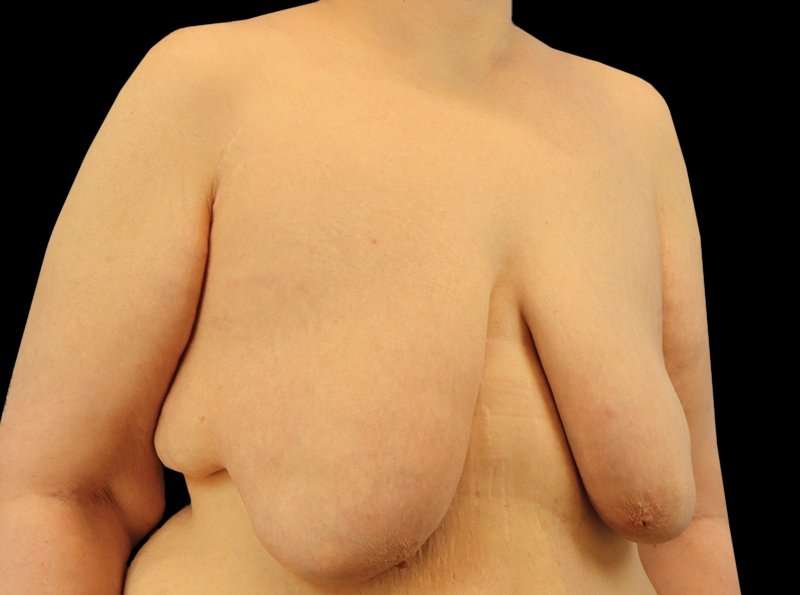 Female To Male Breast Before & After Patient #3966