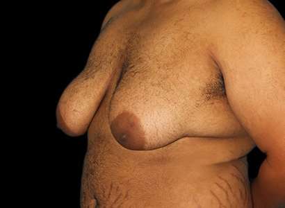 Female To Male Breast Before & After Patient #3984