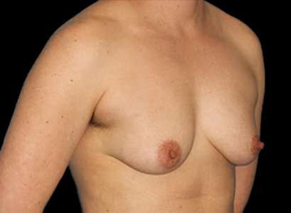Female To Male Breast Before & After Patient #3991