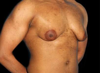 Female To Male Breast Before & After Patient #3998