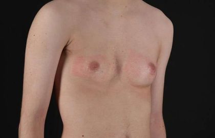 Female To Male Breast Before & After Patient #4031