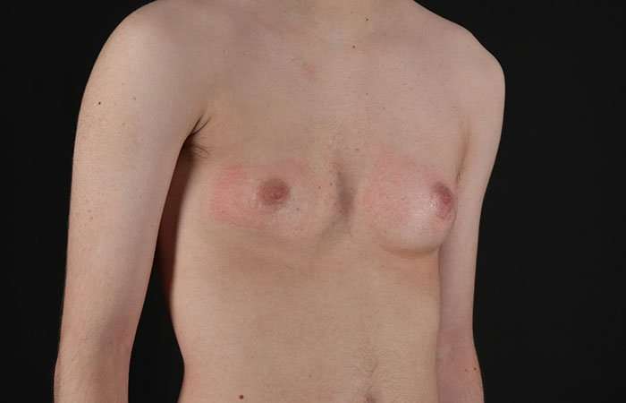 Female To Male Breast Before & After Patient #4031