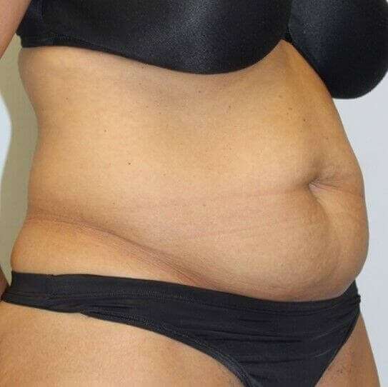 Abdominoplasty (Tummy Tuck) Before & After Patient #889