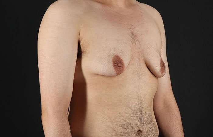 Female To Male Breast Before & After Patient #4042