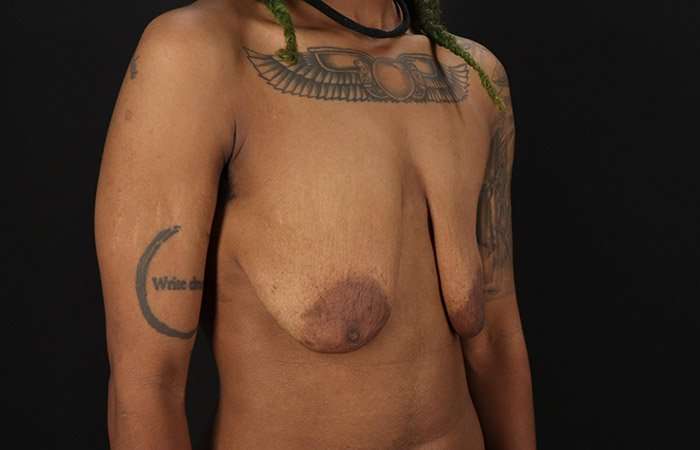 Female To Male Breast Before & After Patient #4053