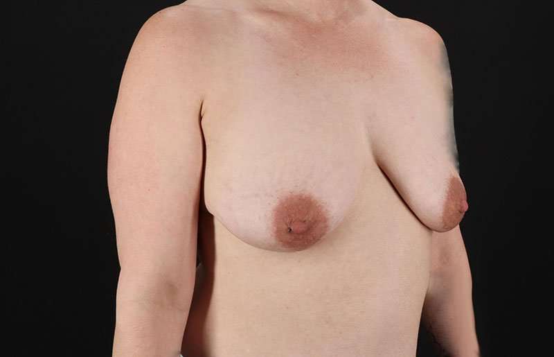 Female To Male Breast Before & After Patient #4064