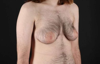 Female To Male Breast Before & After Patient #4075