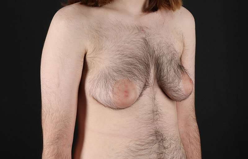 Female To Male Breast Before & After Patient #4075