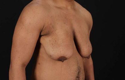 Female To Male Breast Before & After Patient #4086