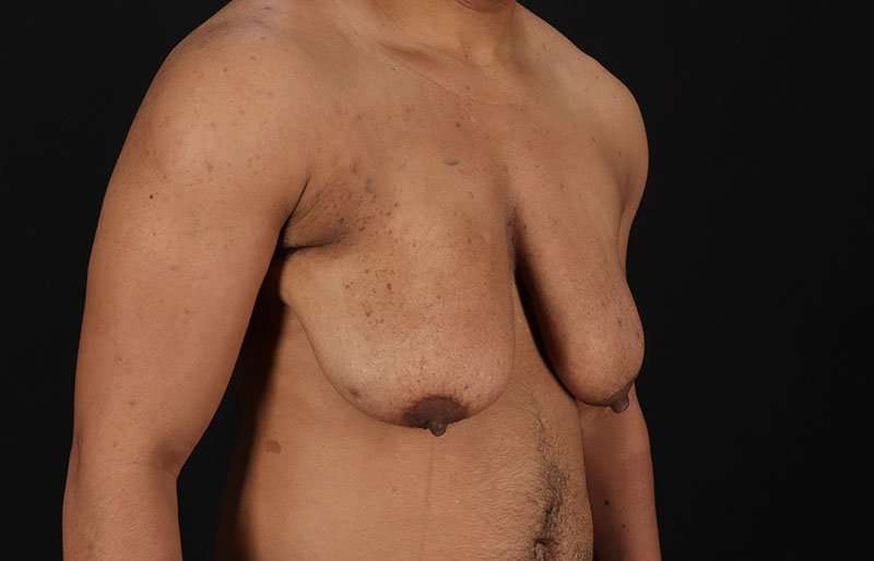 Female To Male Breast Before & After Patient #4086