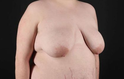 Female To Male Breast Before & After Patient #4097
