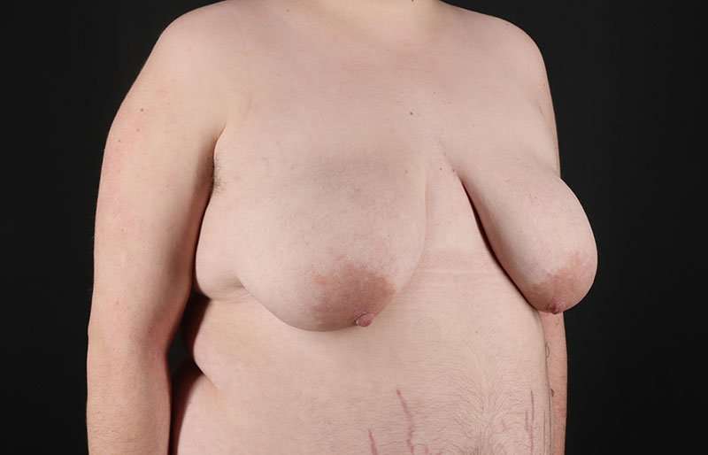 Female To Male Breast Before & After Patient #4097