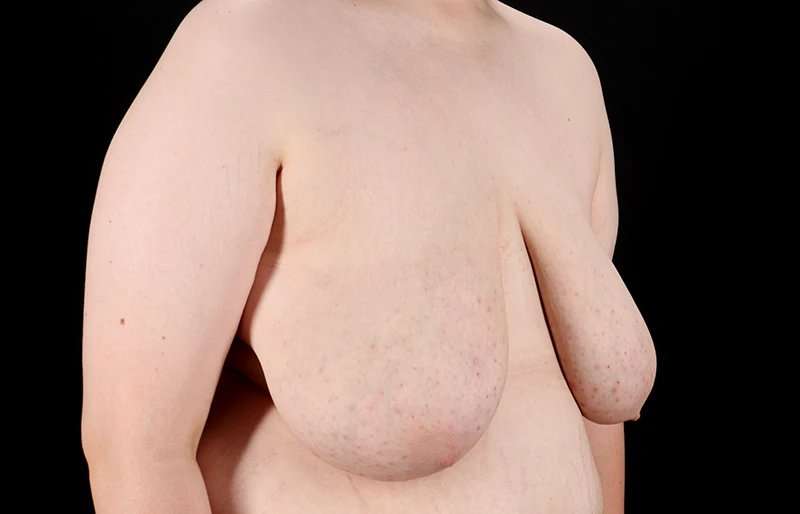 Female To Male Breast Before & After Patient #4130
