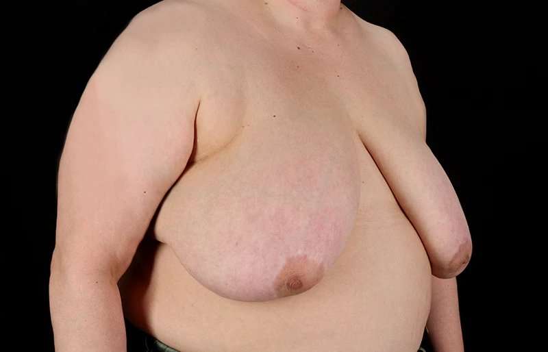 Female To Male Breast Before & After Patient #4141