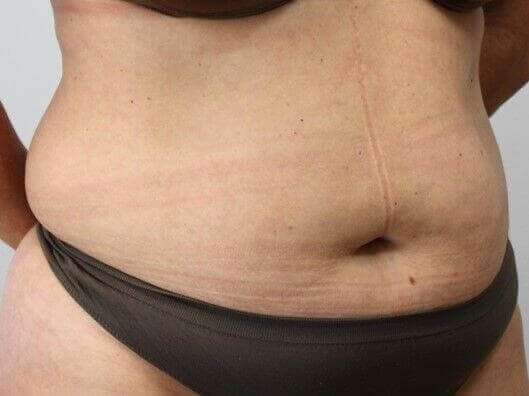 Abdominoplasty (Tummy Tuck) Before & After Patient #897