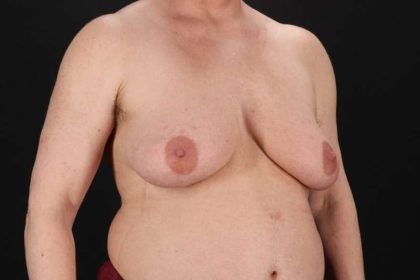 Female To Male Breast Before & After Patient #4152