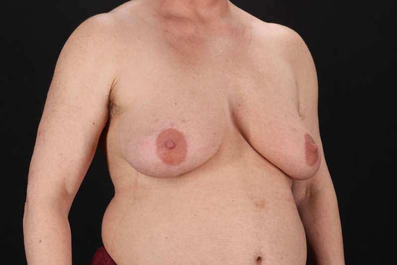 Female To Male Breast Before & After Patient #4152