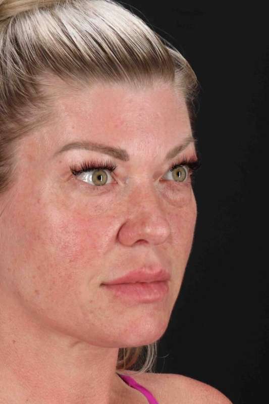 Fat Grafting To The Face Before & After Patient #4232