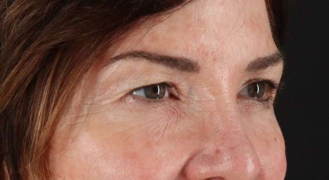 Blepharoplasty (Eyelid Surgery) Before & After Patient #4316