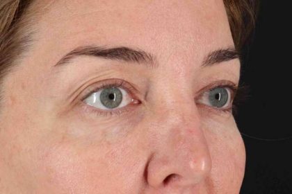 Blepharoplasty (Eyelid Surgery) Before & After Patient #4338