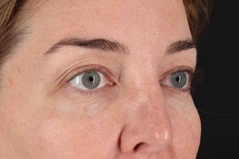 Blepharoplasty (Eyelid Surgery) Before & After Patient #4338