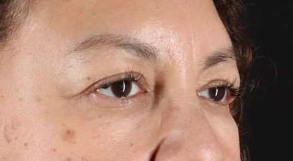 Blepharoplasty (Eyelid Surgery) Before & After Patient #4349